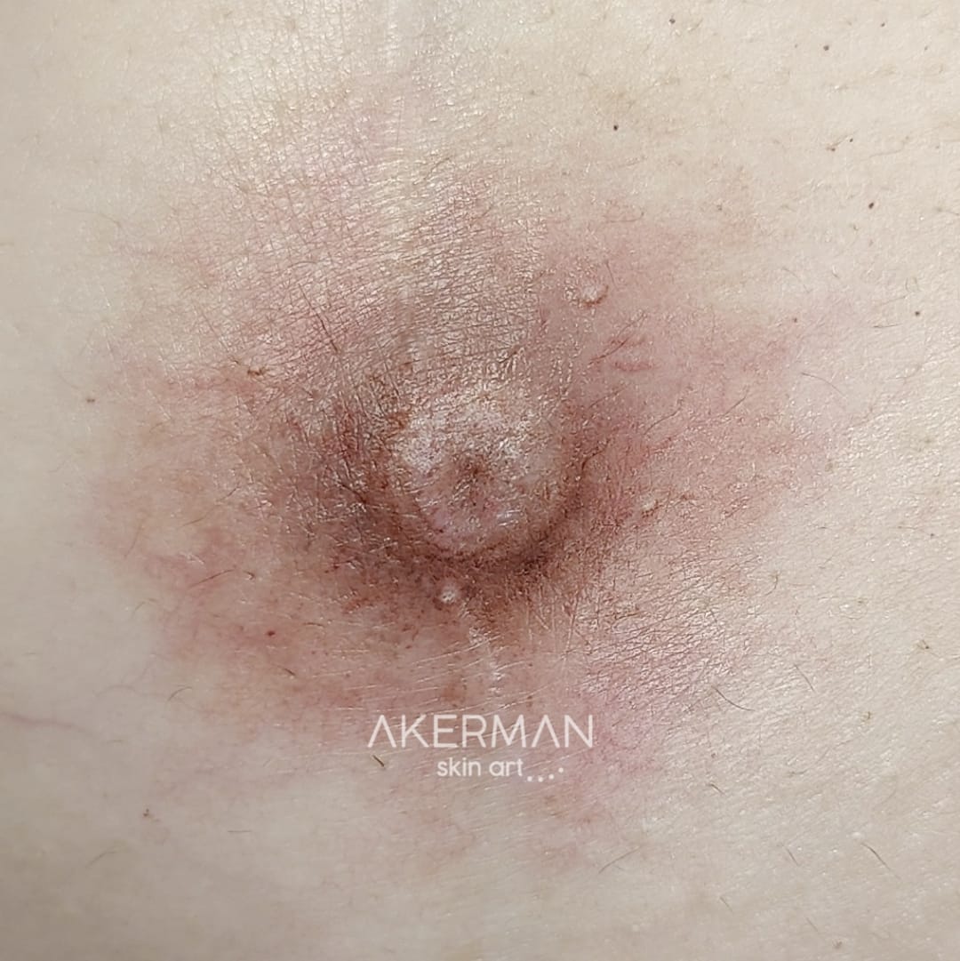 Areolas Mamarias