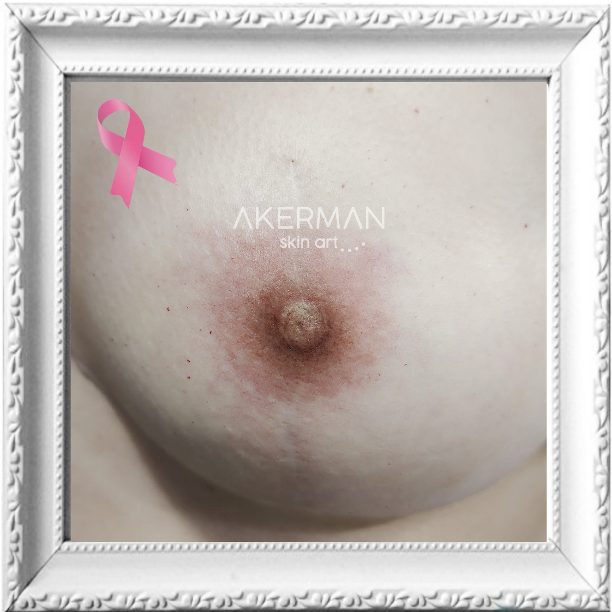 Areolas Mamarias
